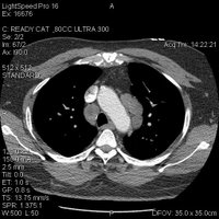 Pulmonary Roundtable: Persistently Enlarged Mediastinal Lymph Nodes